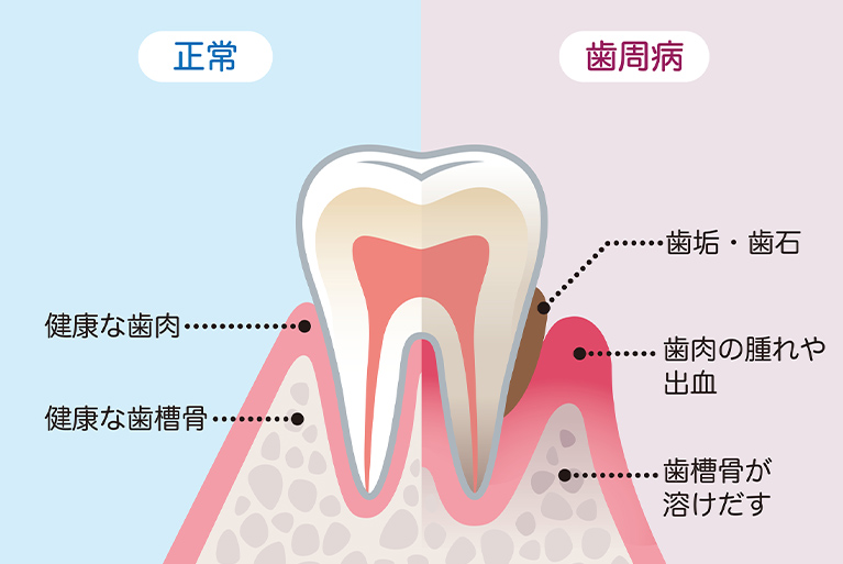 歯周病治療