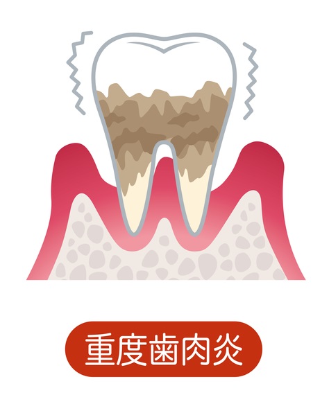 歯周病治療