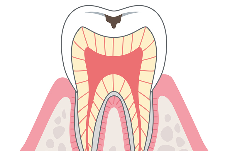 虫歯治療