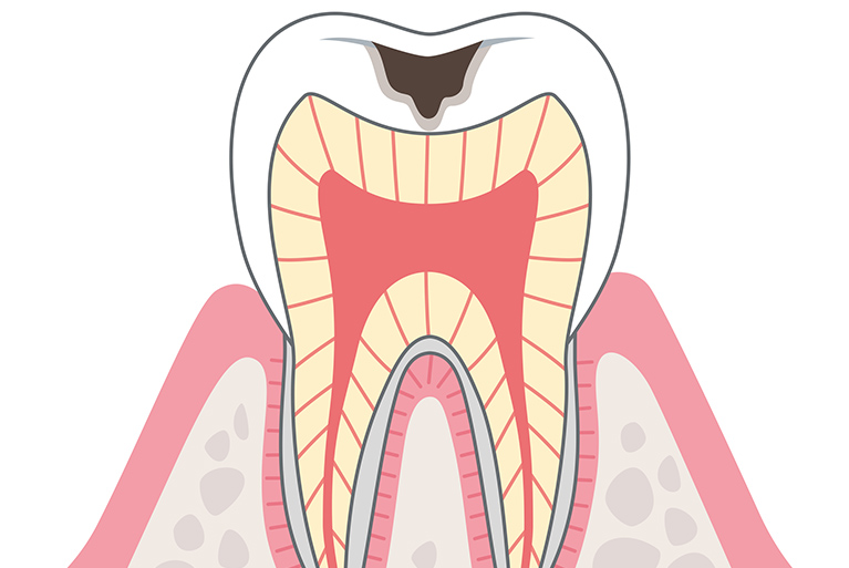虫歯治療