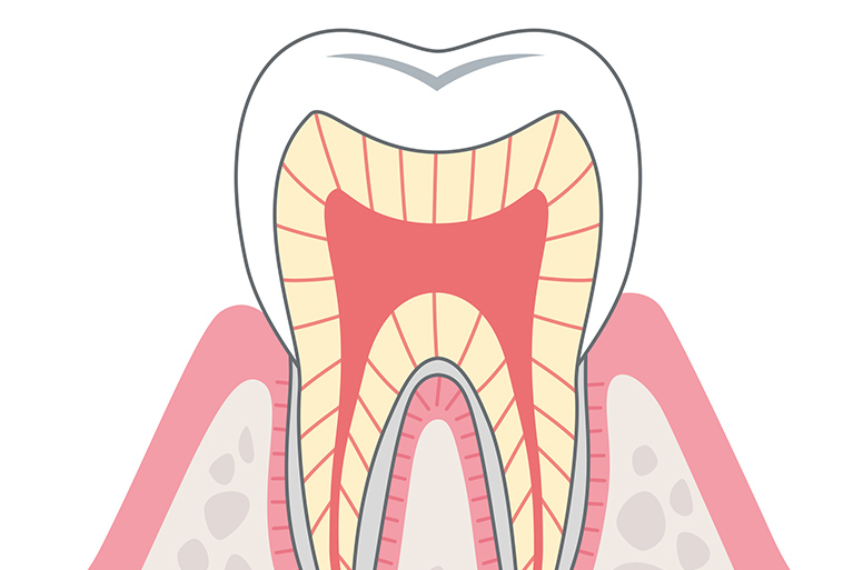 虫歯治療